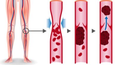 لكيلا تتكون جلطة دموية؛ يجب التأكد من فصائل دم كل من المريض والمتبرع
