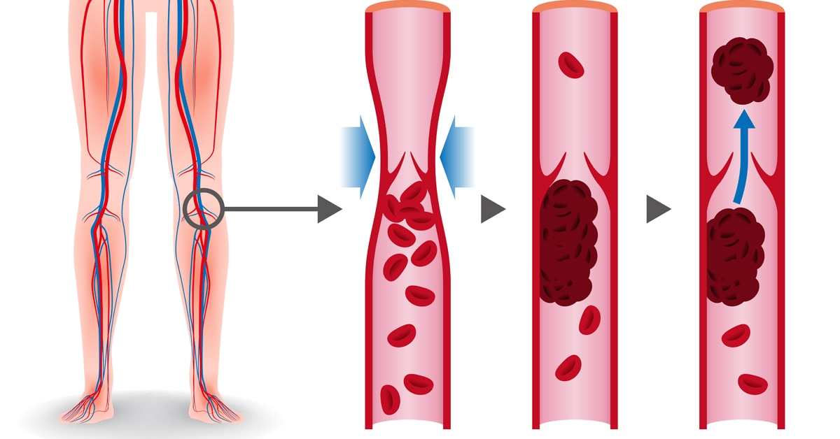 لكيلا تتكون جلطة دموية؛ يجب التأكد من فصائل دم كل من المريض والمتبرع